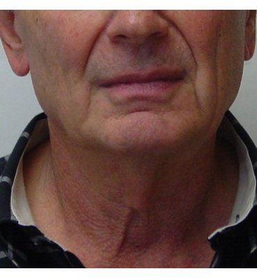 neck lift no scars